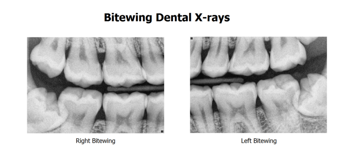 Bitewings initial vertical pan taken figure ijdoh