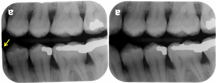 The molar bitewing image should be centered over the